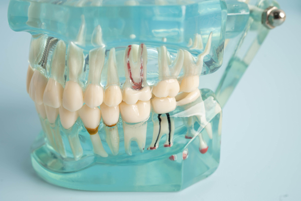Symptoms That Indicate You May Need A Root Canal